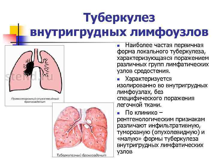 Цирротический туберкулез легких презентация