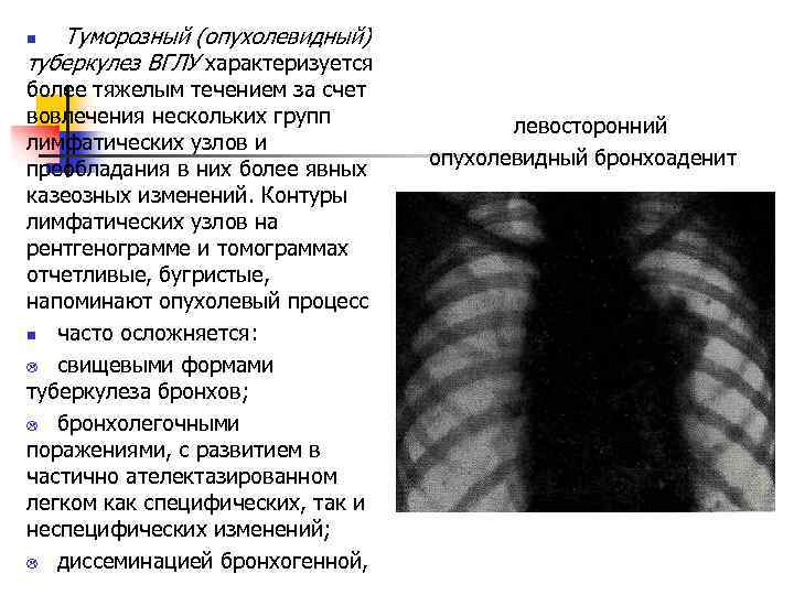  Туморозный (опухолевидный) туберкулез ВГЛУ характеризуется более тяжелым течением за счет вовлечения нескольких групп