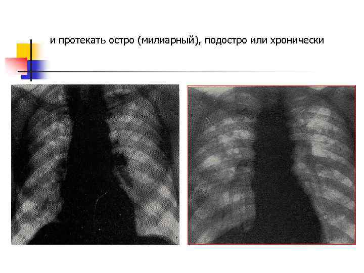 Туберкулез презентация фтизиатрия