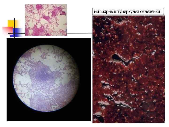  милиарный туберкулез селезенки 