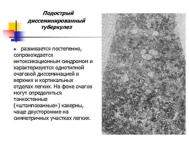  Подострый диссеминированный туберкулез развивается постепенно, сопровождается интоксикационным синдромом и характеризуется однотипной очаговой диссеминацией