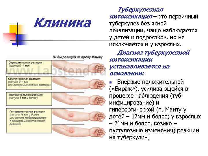 Клиника Туберкулезная интоксикация – это первичный туберкулез без ясной локализации, чаще наблюдается у детей