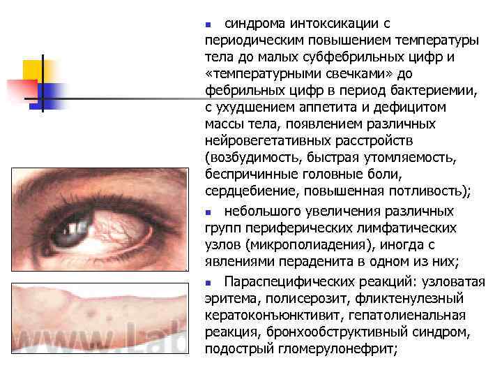 синдрома интоксикации с периодическим повышением температуры тела до малых субфебрильных цифр и «температурными свечками»