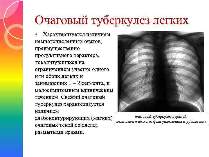 Очаговый туберкулез легких Характеризуется наличием немногочисленных очагов, преимущественно продуктивного характера, локализующихся на ограниченном участке