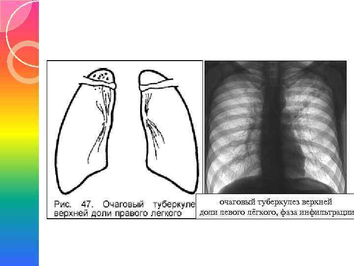 Очаговая форма туберкулеза