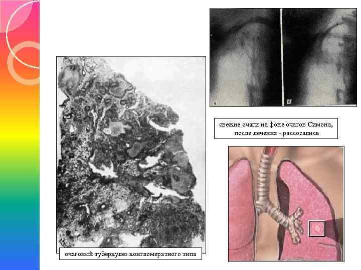 свежие очаги на фоне очагов Симона, после лечения - рассосались очаговый туберкулез конгломератного типа