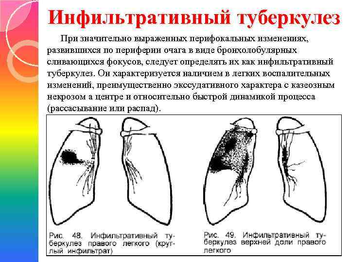 Инфильтративный туберкулез При значительно выраженных перифокальных изменениях, развившихся по периферии очага в виде бронхолобулярных