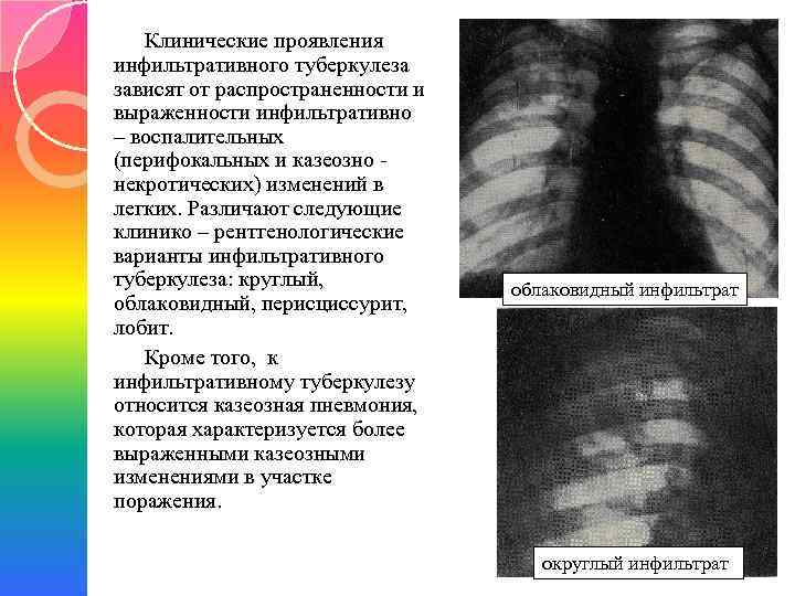 Клинические проявления инфильтративного туберкулеза зависят от распространенности и выраженности инфильтративно – воспалительных (перифокальных и