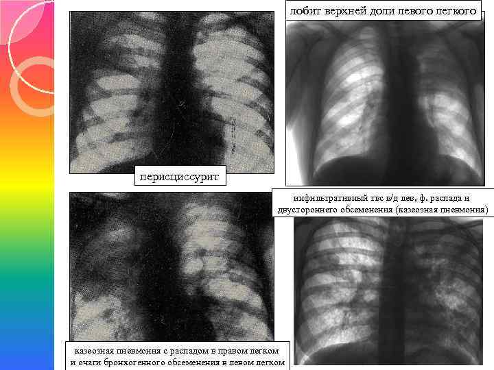 лобит верхней доли левого легкого перисциссурит инфильтративный твс в/д лев, ф. распада и двустороннего