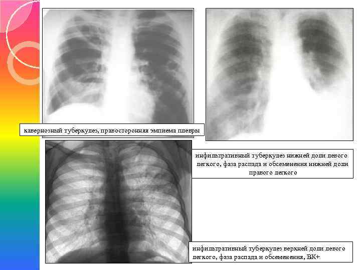 кавернозный туберкулез, правосторонняя эмпиема плевры инфильтративный туберкулез нижней доли левого легкого, фаза распада и