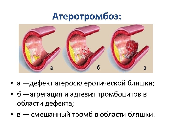 Разрыв бляшки. Разрыв атеросклеротической бляшки. Тромбоциты в атеросклеротической бляшке. Атеросклероз и Атеротромбоз.