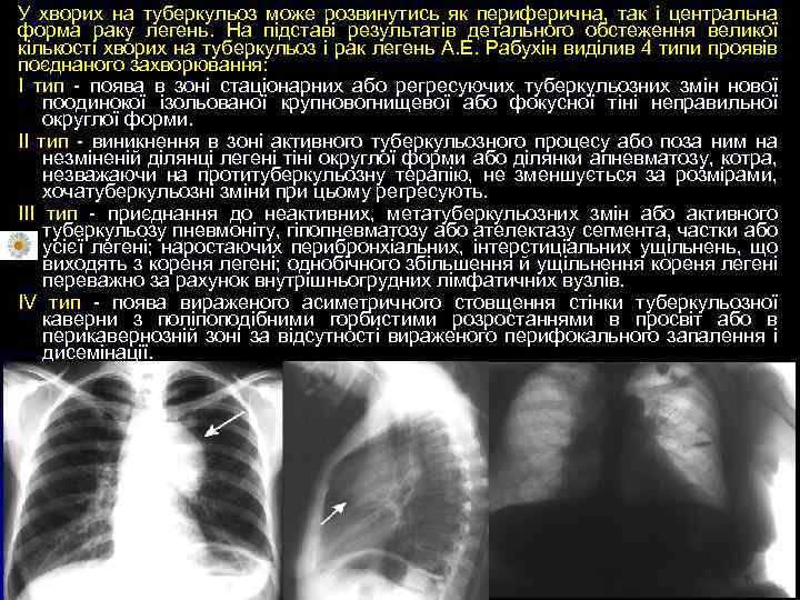 У хворих на туберкульоз може розвинутись як периферична, так і центральна форма раку легень.