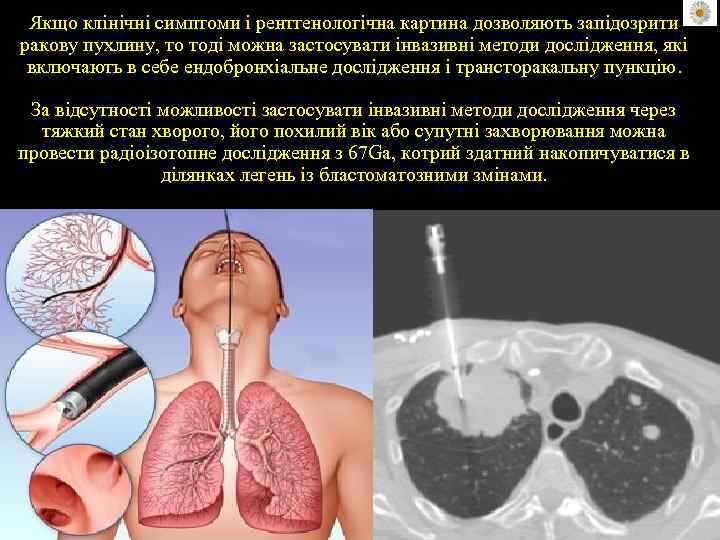 Якщо клінічні симптоми і рентгенологічна картина дозволяють запідозрити ракову пухлину, то тоді можна застосувати