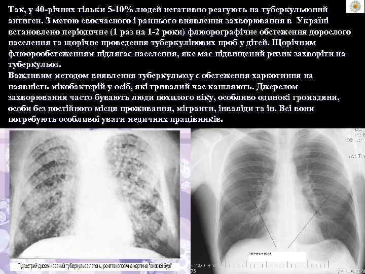 Так, у 40 -річних тільки 5 -10% людей негативно реагують на туберкульозний антиген. З