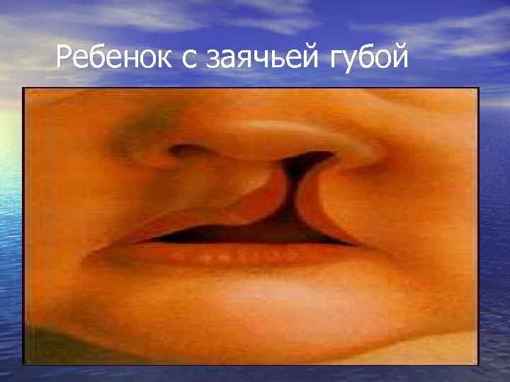 Ребенок с заячьей губой 