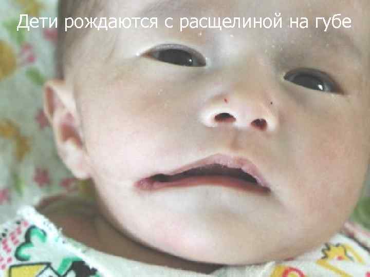 Дети рождаются с расщелиной на губе 