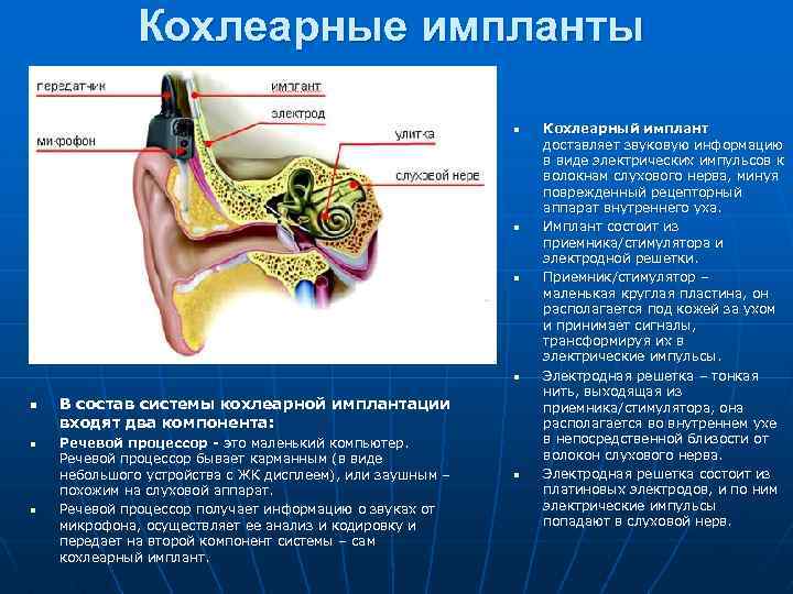 Кохлеарные импланты n n n n В состав системы кохлеарной имплантации входят два компонента: