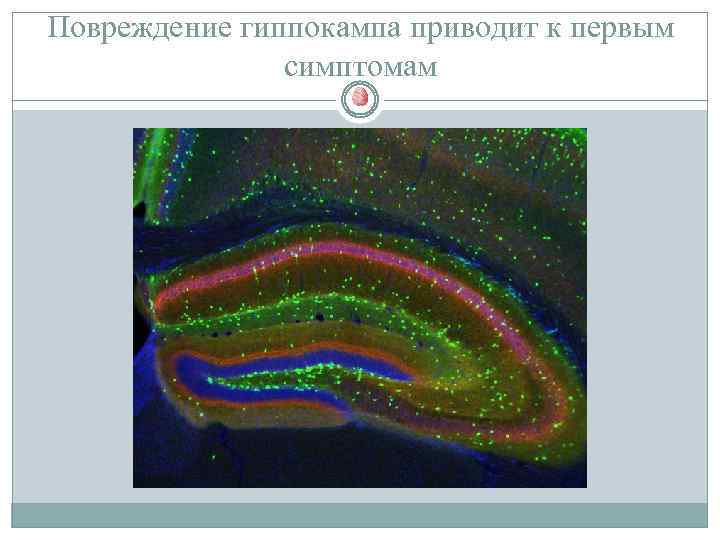 Повреждение гиппокампа приводит к первым симптомам 