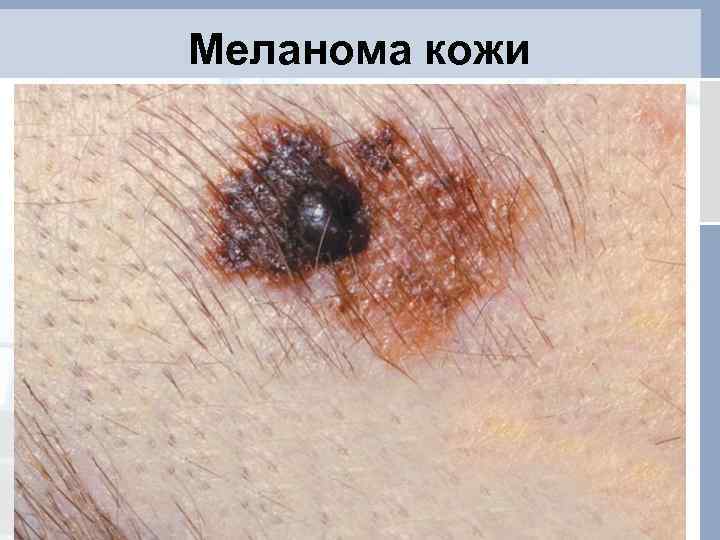 Меланома кожи 