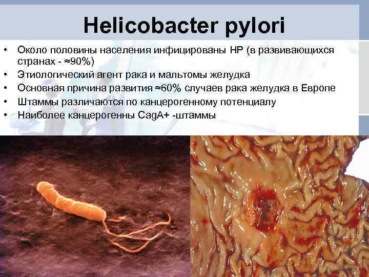 Helicobacter pylori • Около половины населения инфицированы HP (в развивающихся странах - ≈90%) •
