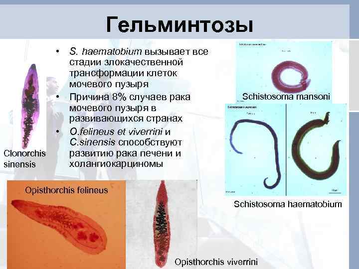 Гельминтозы • S. haematobium вызывает все стадии злокачественной трансформации клеток мочевого пузыря • Причина