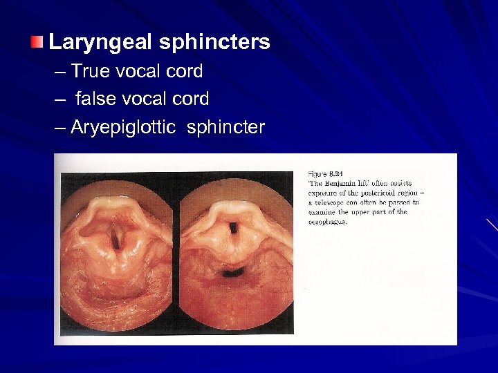 Laryngeal sphincters – True vocal cord – false vocal cord – Aryepiglottic sphincter 