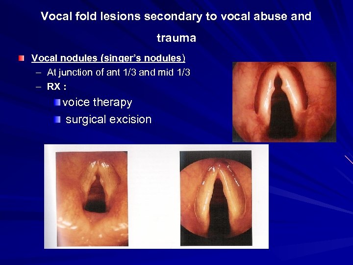 Vocal fold lesions secondary to vocal abuse and trauma Vocal nodules (singer’s nodules) –