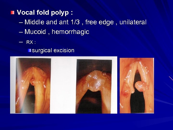 Vocal fold polyp : – Middle and ant 1/3 , free edge , unilateral