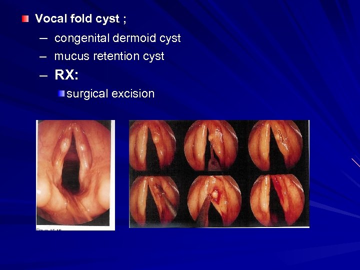 Vocal fold cyst ; – congenital dermoid cyst – mucus retention cyst – RX: