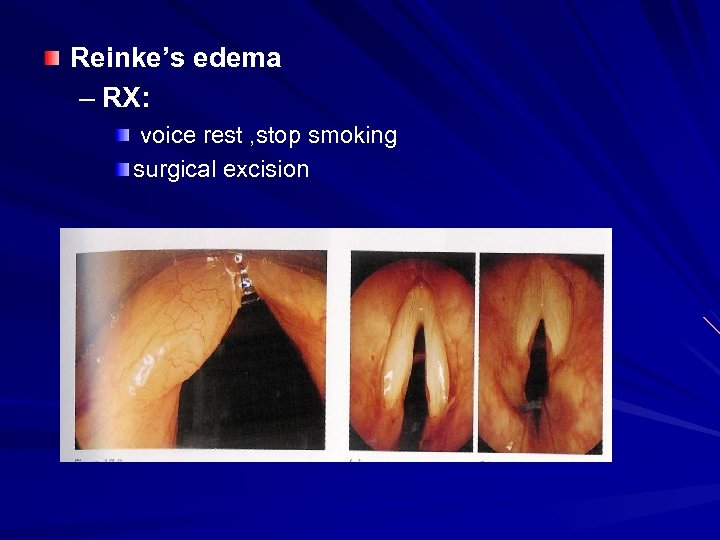 Reinke’s edema – RX: voice rest , stop smoking surgical excision 