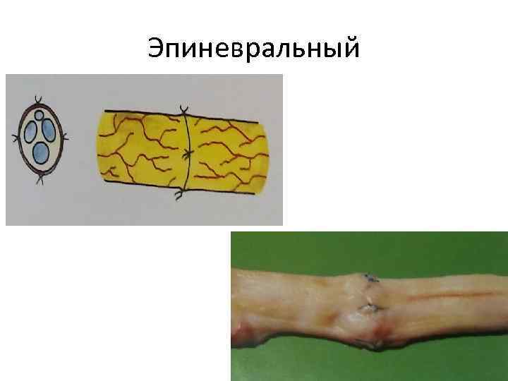 Эпиневральный 