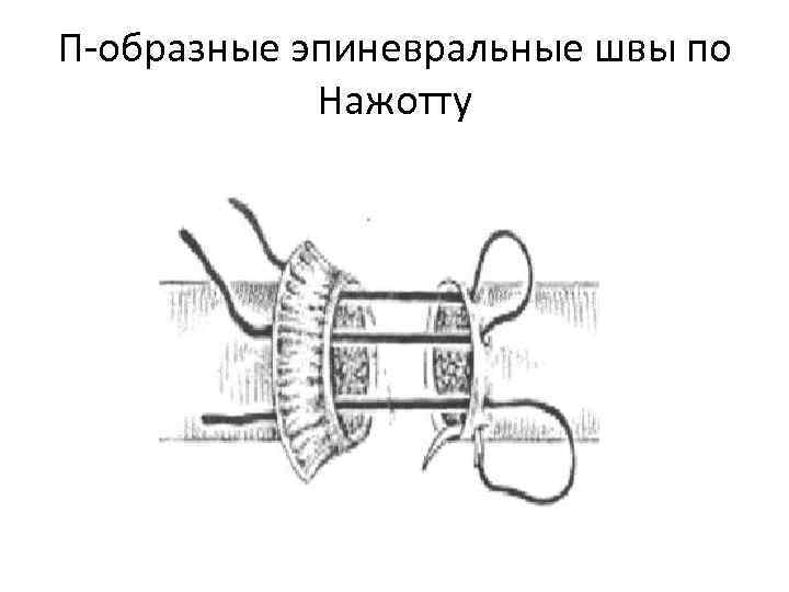 П-образные эпиневральные швы по Нажотту 
