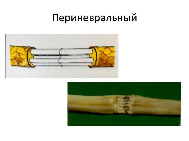 Периневральный 