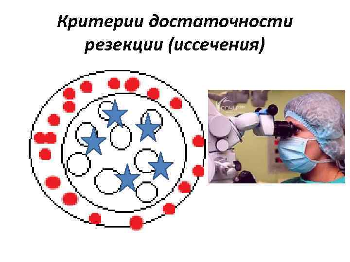 Критерии достаточности резекции (иссечения) 