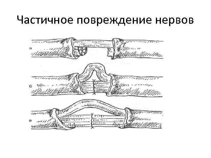 Частичное повреждение нервов 