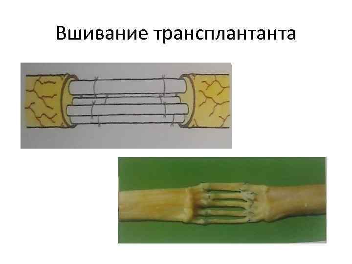 Вшивание трансплантанта 