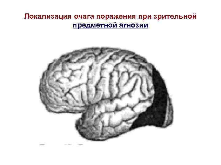 Расстройство схемы тела отмечается при поражении