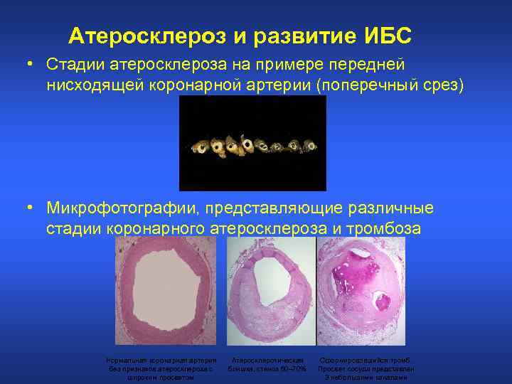 Атеросклероз и развитие ИБС • Стадии атеросклероза на примере передней нисходящей коронарной артерии (поперечный