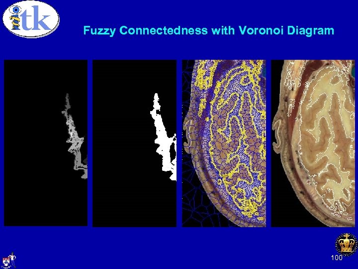 Fuzzy Connectedness with Voronoi Diagram Fuzzy Connectedness: Fuzzy map Binary image from which we