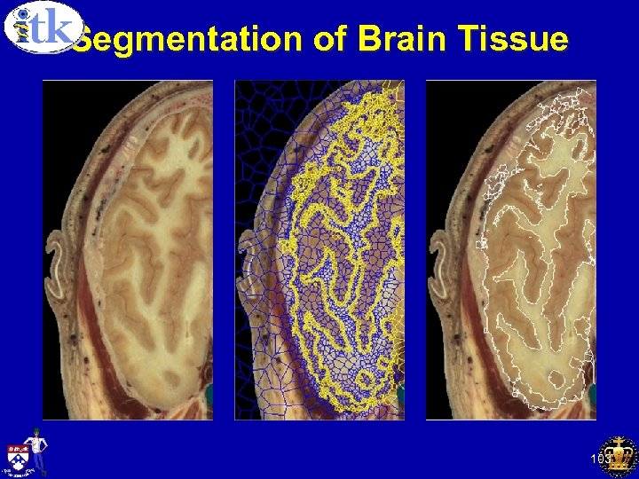 Segmentation of Brain Tissue 103 