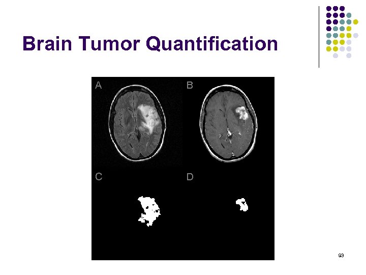 Brain Tumor Quantification A B C D 93 