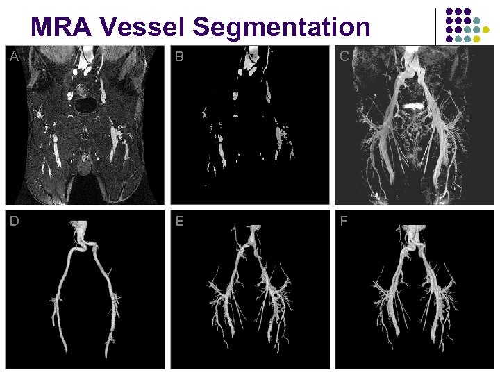 MRA Vessel Segmentation A B C D E F 94 