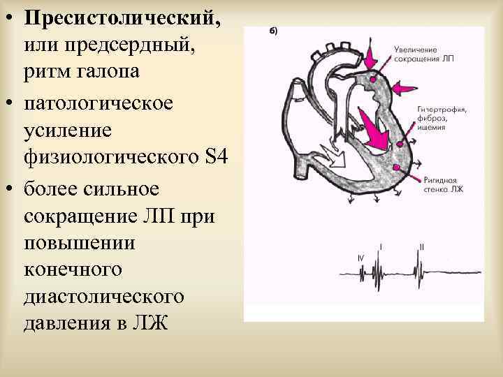  • Пресистолический, или предсердный, ритм галопа • патологическое усиление физиологического S 4 •