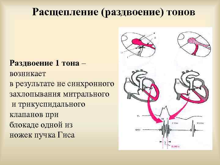 Расщепление (раздвоение) тонов Раздвоение 1 тона – возникает в результате не синхронного захлопывания митрального