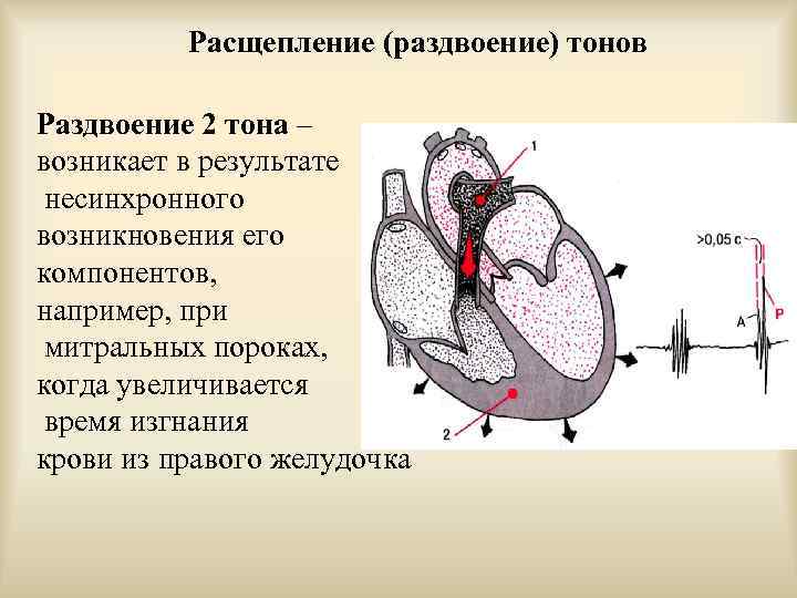 Расщепление (раздвоение) тонов Раздвоение 2 тона – возникает в результате несинхронного возникновения его компонентов,