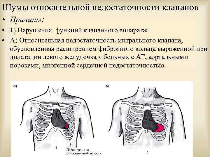 Шумы относительной недостаточности клапанов • Причины: • 1) Нарушения функций клапанного аппарата: • А)