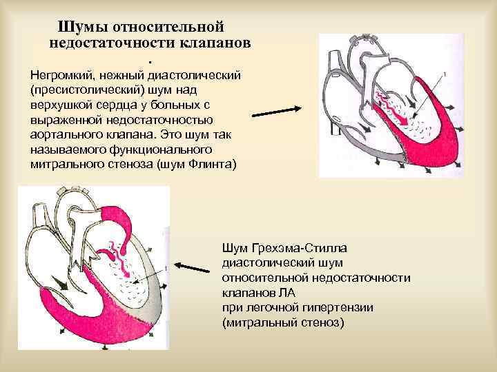 Шумы относительной недостаточности клапанов Негромкий, нежный диастолический (пресистолический) шум над верхушкой сердца у больных