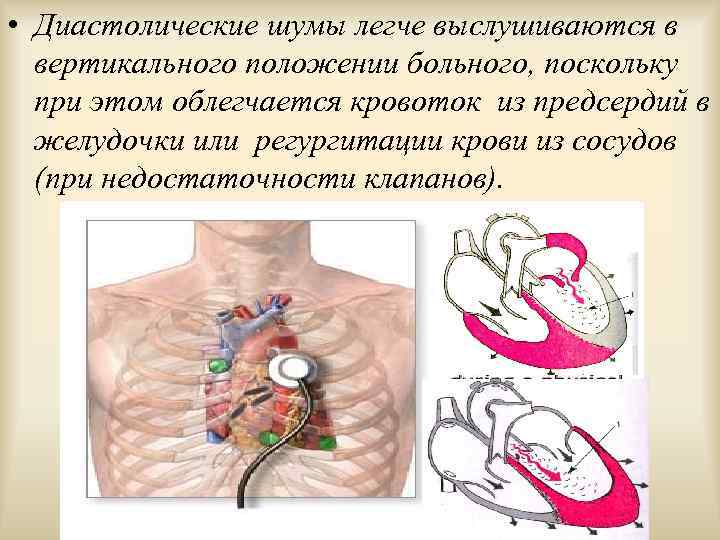  • Диастолические шумы легче выслушиваются в вертикального положении больного, поскольку при этом облегчается