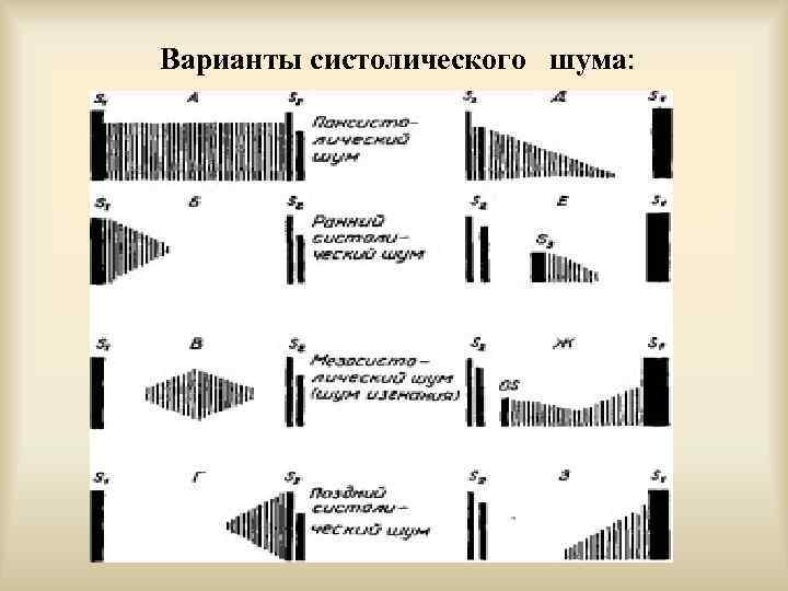 Варианты систолического шума: 