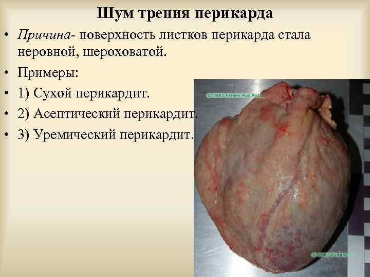 Шум трения перикарда • Причина- поверхность листков перикарда стала неровной, шероховатой. • Примеры: •